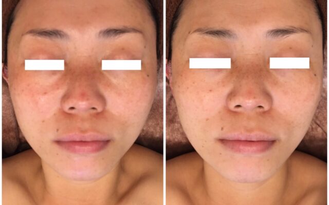 お顔のたるみを解消して小顔に！