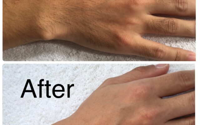 メンズにもおすすめ！美肌脱毛