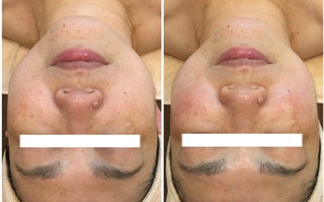 フェイスラインがスッキリ！