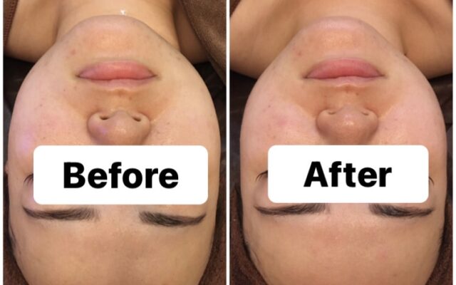 毛穴の開き・ざらつき・ごわつきなお肌に