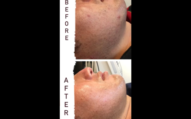 メンズ脱毛☆急増中！