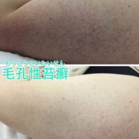 二の腕のぶつぶつ・ザラザラが気になる方へ